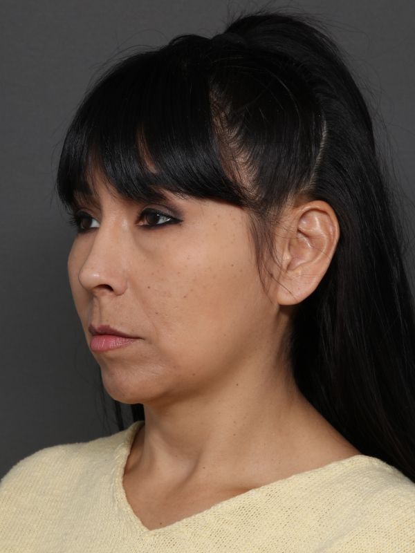 Facelift Before & After Image