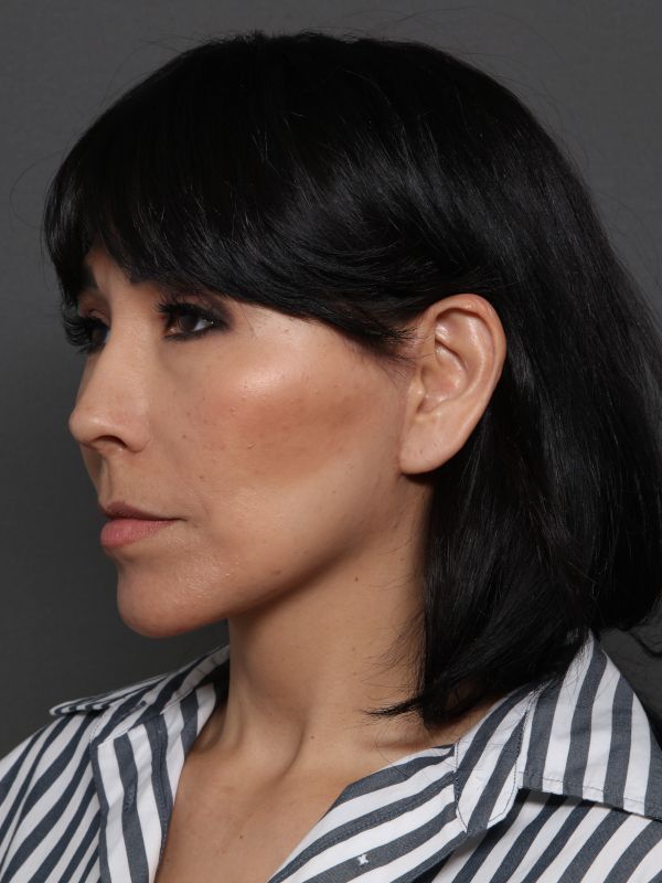 Facelift Before & After Image