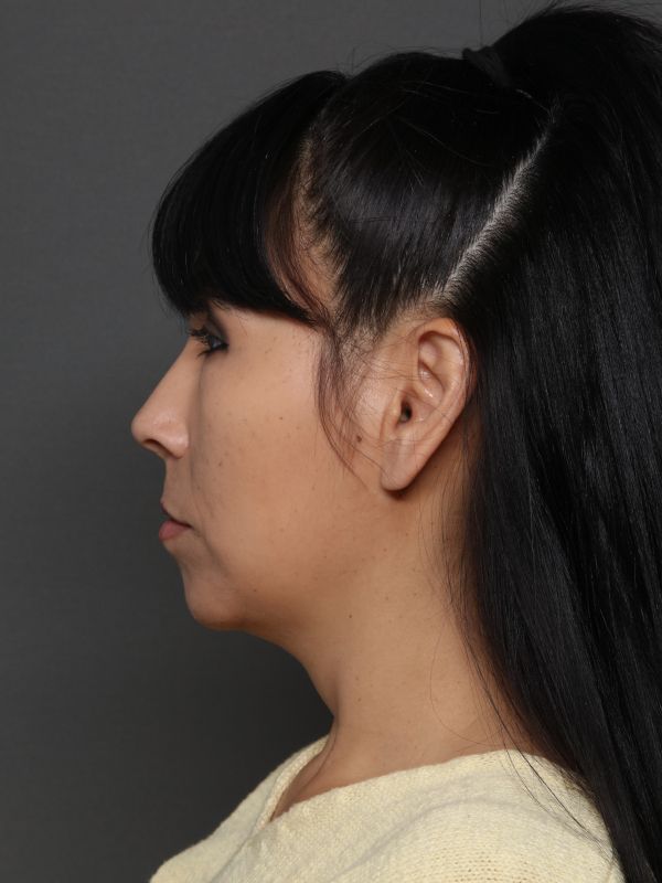 Facelift Before & After Image