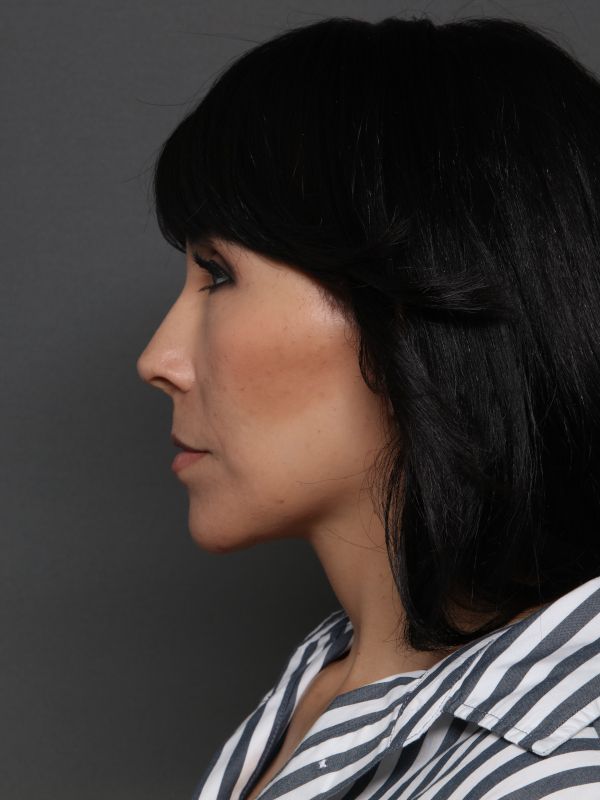 Facelift Before & After Image