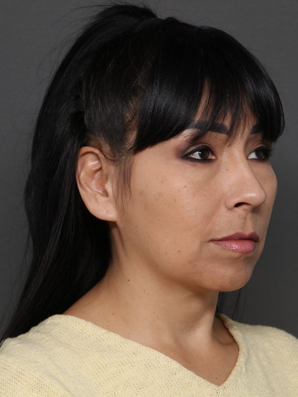 Facelift Before & After Image