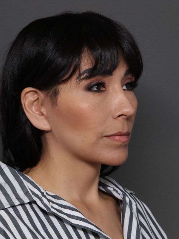 Facelift Before & After Image