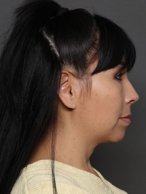 Facelift Before & After Image