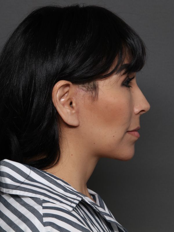 Facelift Before & After Image