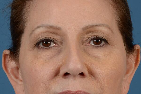 Lower Lid Blepharoplasty Before & After Image