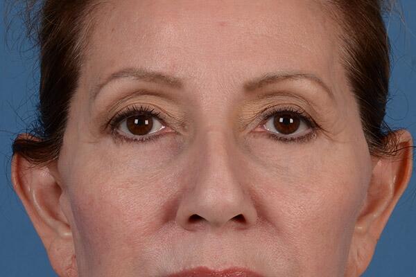 Lower Lid Blepharoplasty Before & After Image