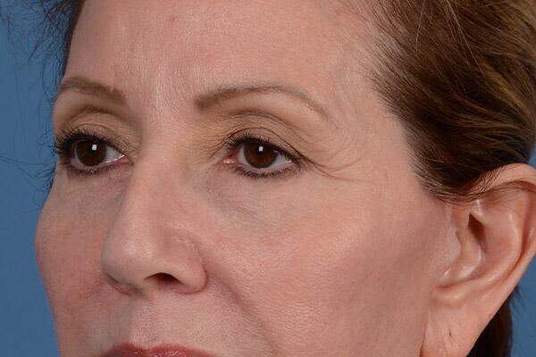 Lower Lid Blepharoplasty Before & After Image