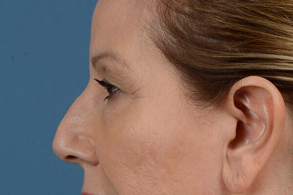 Lower Lid Blepharoplasty Before & After Image