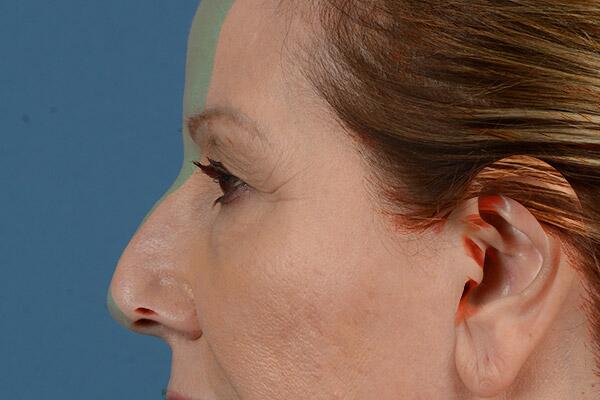 Lower Lid Blepharoplasty Before & After Image