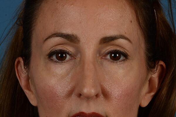 Lower Lid Blepharoplasty Before & After Image