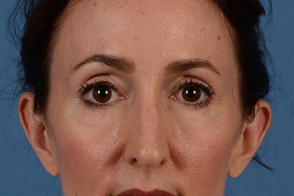 Lower Lid Blepharoplasty Before & After Image