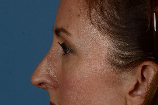 Lower Lid Blepharoplasty Before & After Image