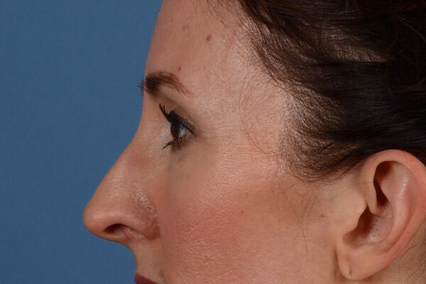 Lower Lid Blepharoplasty Before & After Image