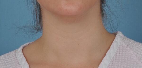 Neck Lift Before & After Image