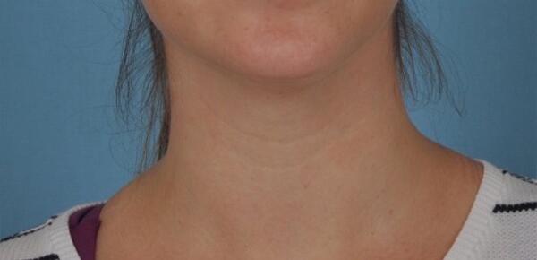 Neck Lift Before & After Image