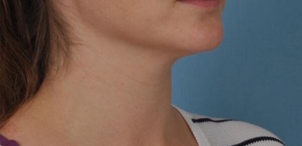 Neck Lift Before & After Image