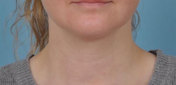 Neck Lift Before & After Image