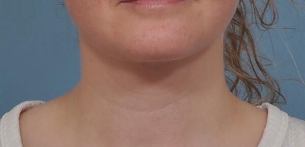 Neck Lift Before & After Image