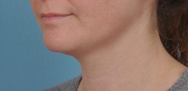 Neck Lift Before & After Image