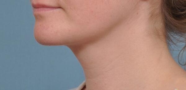 Neck Lift Before & After Image