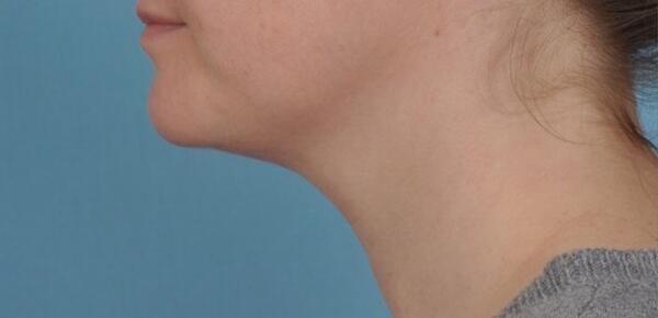 Neck Lift Before & After Image