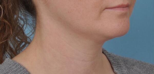 Neck Lift Before & After Image