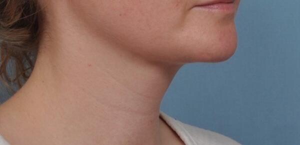 Neck Lift Before & After Image