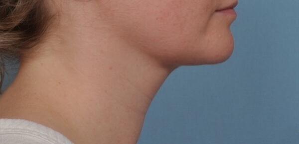 Neck Lift Before & After Image