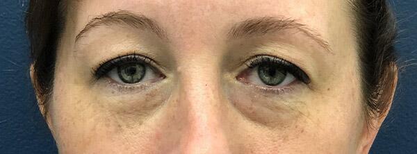 Upper Lid Blepharoplasty Before & After Image