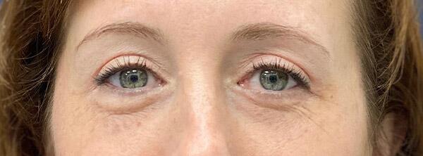 Upper Lid Blepharoplasty Before & After Image