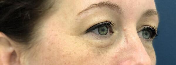 Upper Lid Blepharoplasty Before & After Image