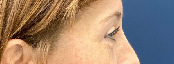 Upper Lid Blepharoplasty Before & After Image