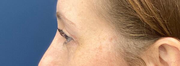 Upper Lid Blepharoplasty Before & After Image