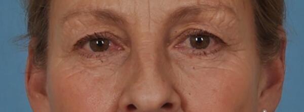 Upper Lid Blepharoplasty Before & After Image