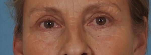 Upper Lid Blepharoplasty Before & After Image