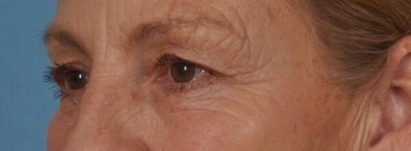 Upper Lid Blepharoplasty Before & After Image