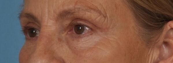 Upper Lid Blepharoplasty Before & After Image