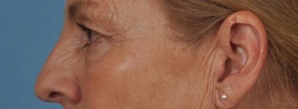 Upper Lid Blepharoplasty Before & After Image