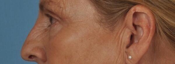 Upper Lid Blepharoplasty Before & After Image