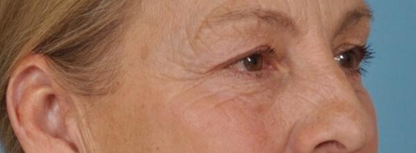 Upper Lid Blepharoplasty Before & After Image