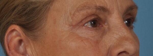 Upper Lid Blepharoplasty Before & After Image