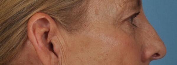 Upper Lid Blepharoplasty Before & After Image