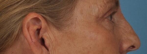 Upper Lid Blepharoplasty Before & After Image