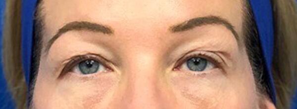 Upper Lid Blepharoplasty Before & After Image