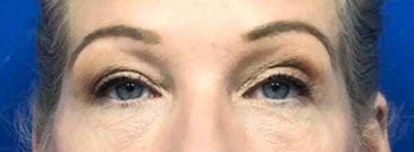 Upper Lid Blepharoplasty Before & After Image