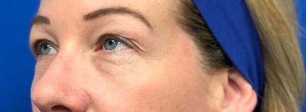 Upper Lid Blepharoplasty Before & After Image