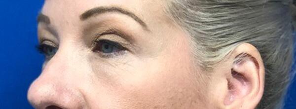 Upper Lid Blepharoplasty Before & After Image