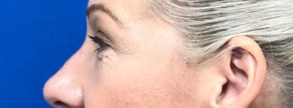 Upper Lid Blepharoplasty Before & After Image