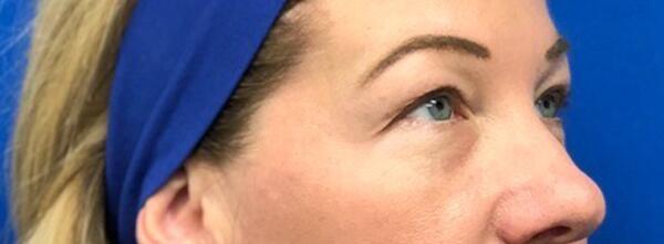 Upper Lid Blepharoplasty Before & After Image