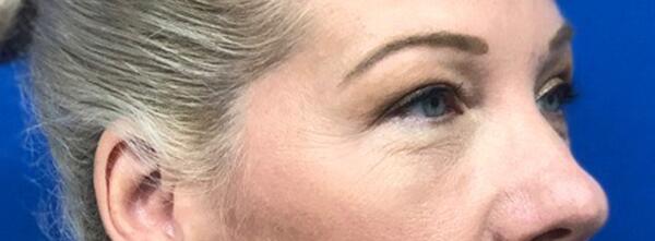 Upper Lid Blepharoplasty Before & After Image